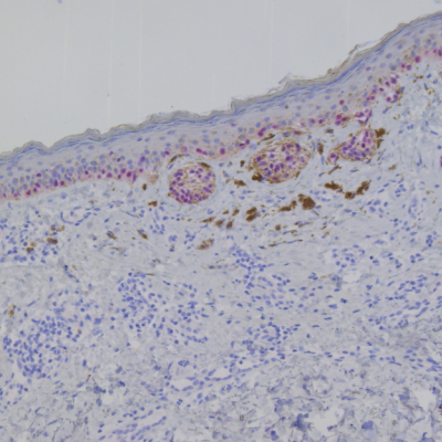 Diagnosis of cutaneous tumours