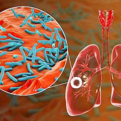 Lääkärit Ilman Rajoja: Tuberkuloositestien saatavuutta parannettava