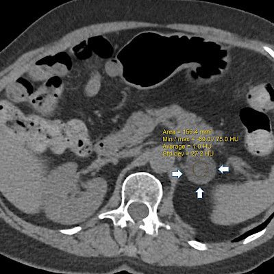 Most adrenal incidentalomas do not require routine follow-up