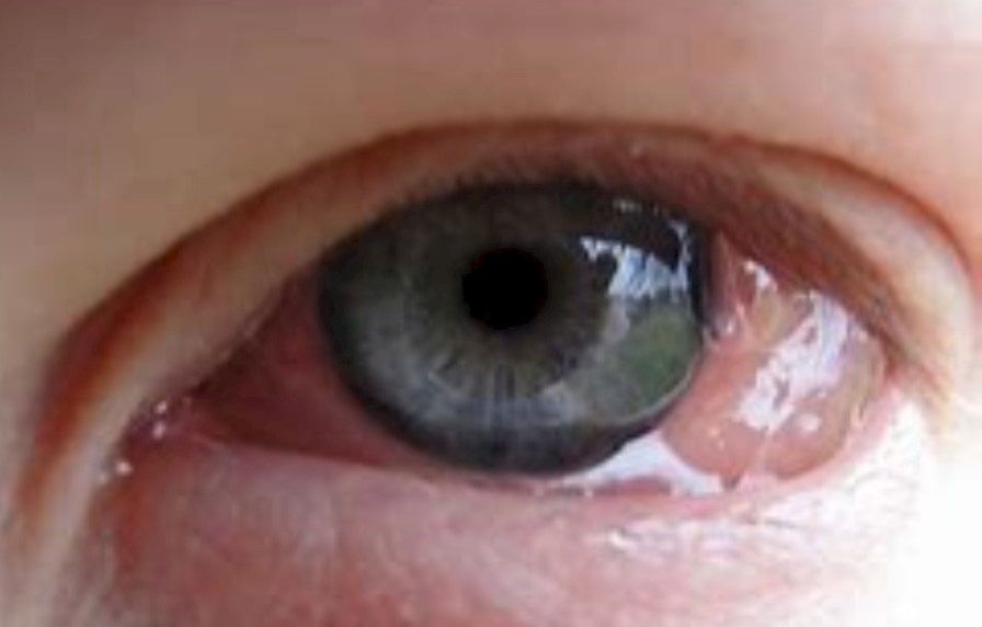 Allergisella sidekalvotulehduksella on monta taudinkuvaa Lääkärilehti