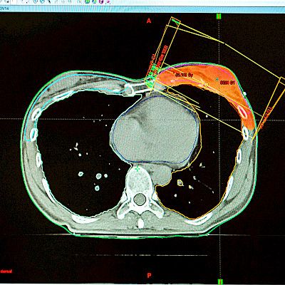 The wide spectrum of complications of radiotherapy for breast cancer