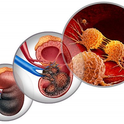 Diagnosis and management of renal cell carcinoma