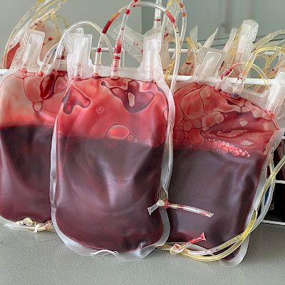 Severe haemolytic transfusion reaction