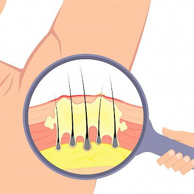 Biologisia lääkkeitä hikirauhasten vaikeaan tulehdukseen