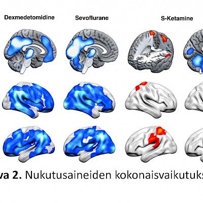 Anestesiassa nukahtaminen yhteydessä talamuksen aktiivisuuden vähenemiseen