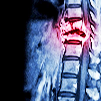 Treatment of skeletal metastases