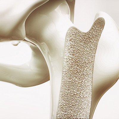 Murtumapotilaiden osteoporoosin lääkehoidossa on isoja alueellisia eroja