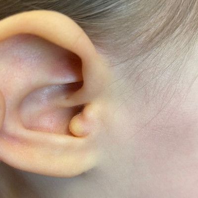 Congenital anomalies of the head and neck region in children
