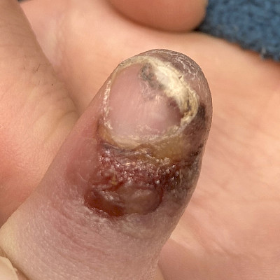 Miksi sormen tulehdus ei parane?