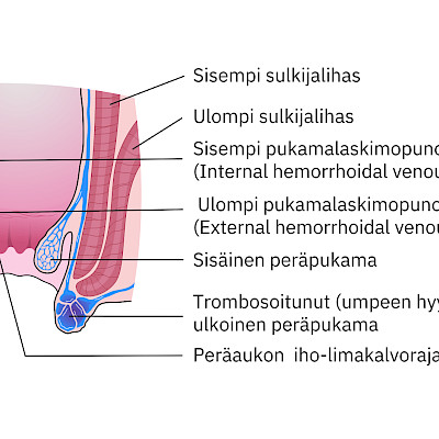Peräpukamien nykyhoito – konservatiiviset keinot, ligeeraus vai leikkaus?