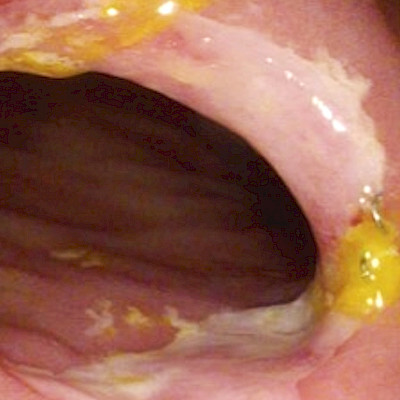 Short bowel syndrome requires multidisciplinary care and long term follow up