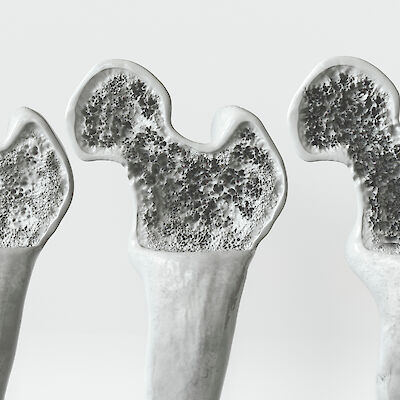 Näin valitset osteoporoosilääkkeen lonkkamurtuman jälkeen