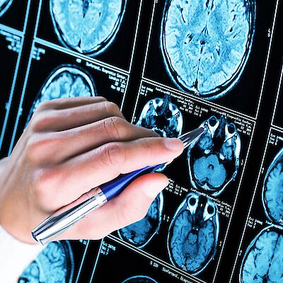 Alzheimerin taudin diagnostiikassa voi hyödyntää verikoetta