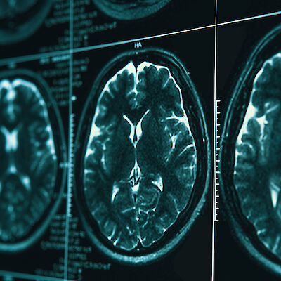 Uusi kohde tulossa Alzheimerin taudin ehkäisyyn?