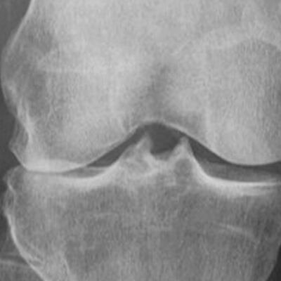 Miten polven rappeutumista diagnosoidaan?