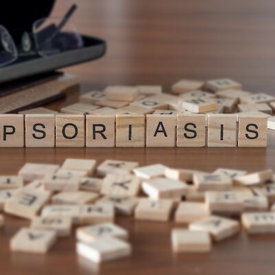 Uusi tablettihoito psoriaasiin osoittautui tehokkaaksi