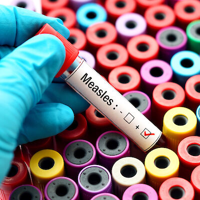 THL luopuu tuhkarokon primääridiagnostiikasta