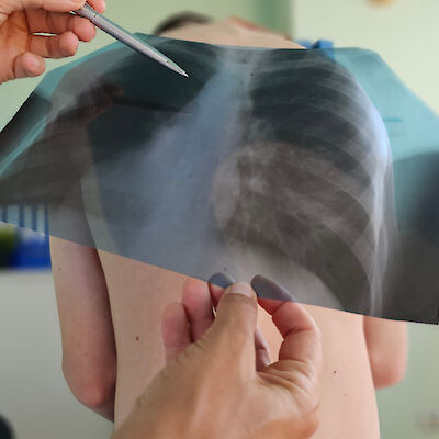 Ensimmäinen lääke tulossa vaikeaan keuhkosairauteen