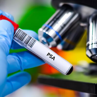 Miten suhtautua PSA:n myöhäisresidiiviin radikaalin prostatektomian jälkeen?
