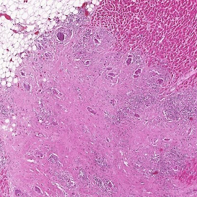 Sydänsarkoidoosin ennuste on parantunut – mutta äkkikuolemia on yhä