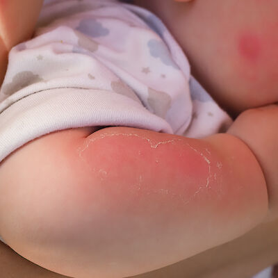 Xeroderma pigmentosum aiheuttaa ennenaikaisen vanhenemisen