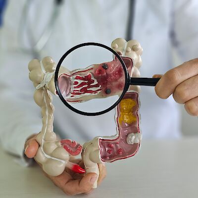 Suolistosyövän seulonnan osallistumisaste yli 70 prosenttia – erot väestöryhmien välillä suuria