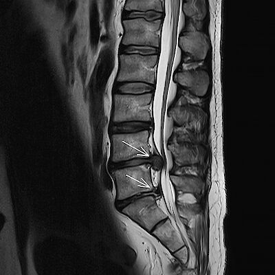 Onko alaselkäkipuisen kuvantamisesta hyötyä?