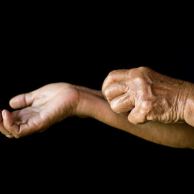 Uusi atooppisen ihottuman lääke korvattavaksi