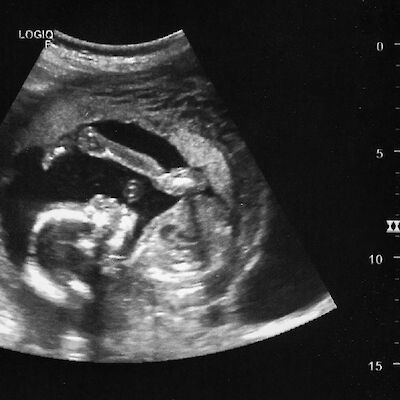 Kätilövetoinen raskauden ultraääni on lainvastainen