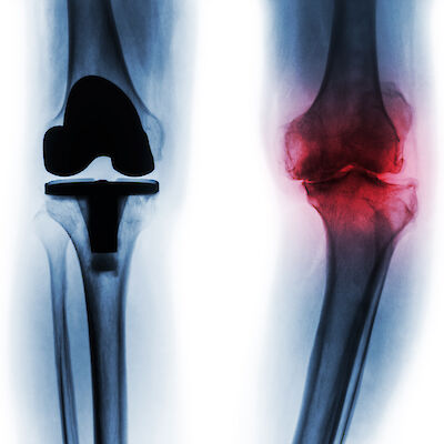 Hus perustaa oman tekonivelsairaalan Helsinkiin