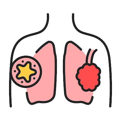 Biologiset lääkkeet keuhkoahtaumataudissa – milloin niistä on hyötyä?