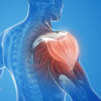 Lähes kaikilla yli nelikymppisillä on muutoksia olkapäissä