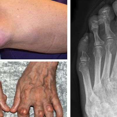 Kihtiä tulee hoitaa kokonaisvaltaisesti – muista liitännäissairaudet