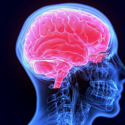 Toinen verikoe Alzheimerin taudin diagnostiikkaan Itä-Suomen yliopistossa