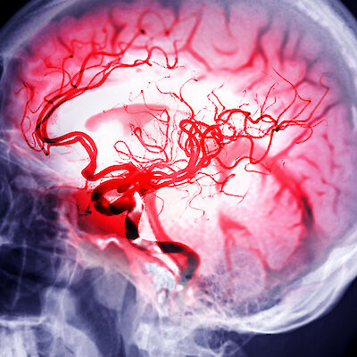 Vastikään sairastettu infektio lisää aivoinfarktin riskiä nuorilla aikuisilla
