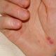 Enterorokkoa epidemiaksi asti