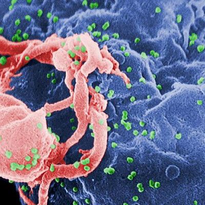 CD4-solujen niukkuus lisää syöpäriskiä HIV-potilaalla