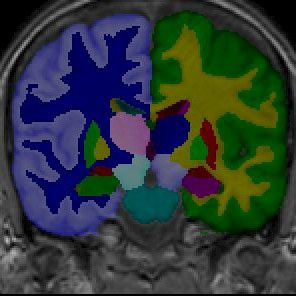 VTT kehitti nopean kuva-analyysin Alzheimerin toteamiseksi