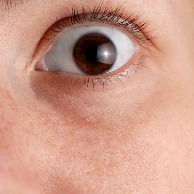 Valtaosa silmätautien potilasvahinkoilmoituksista tehdään kirurgisista toimenpiteistä