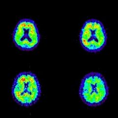 Alzheimerin taudin aivomuutokset havaittavissa jo ennen oireita?