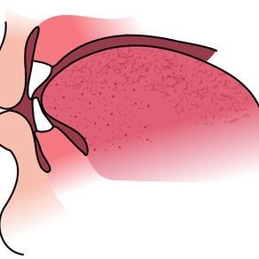 HPV on vahva itsenäinen ennustetekijä suunielun syövässä