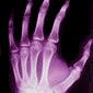 Uusi hypoteesi osteoporoosin syntymekanismista
