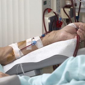Varhain aloitettu dialyysi voi olla haitaksi