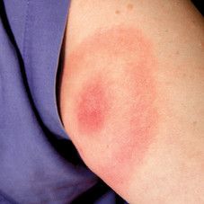 Lääkärit tunnistavat ­borreliatartunnat entistä paremmin