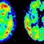 Lievä muistin heikentyminen lisää Alzheimerin taudin riskiä