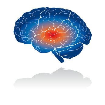 Magneettistimulaatio toi uutta tietoa suomalaisen tautiperimän epilepsiasta