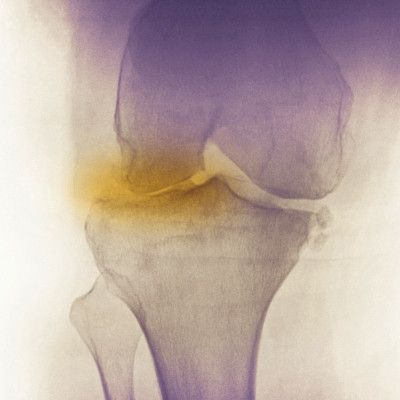 Fysioterapia usein riittävä rappeumaperäisessä polvivaivassa