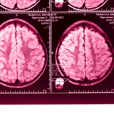 Psykologiset tekijät vaikuttavat lievän aivovamman jälkioireisiin